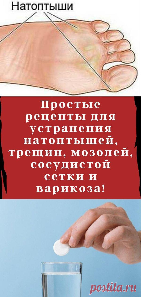 Простые рецепты для устранения натоптышей, трещин, мозолей, сосудистой сетки и варикоза!
