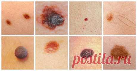 Учимся определять и предотвращать рак кожи