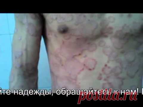 Реальное лечение псориаза.