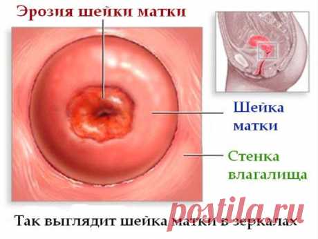 Что такое эрозия шейки матки, ее причины и последствия