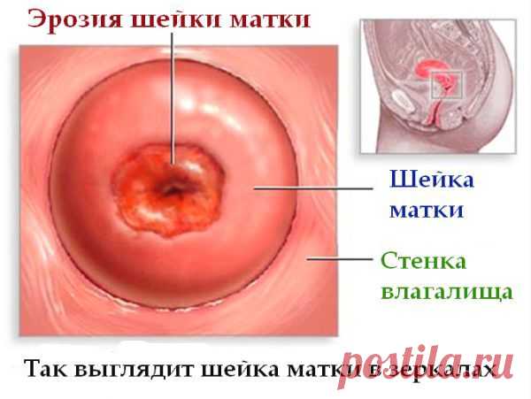 Что такое эрозия шейки матки, ее причины и последствия