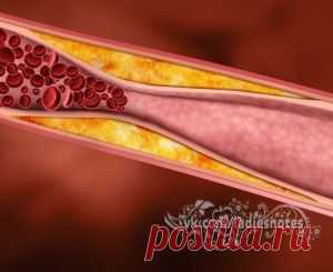 СНИЖЕНИЕ ХОЛЕСТЕРИНА НАРОДНЫМИ СРЕДСТВАМИ