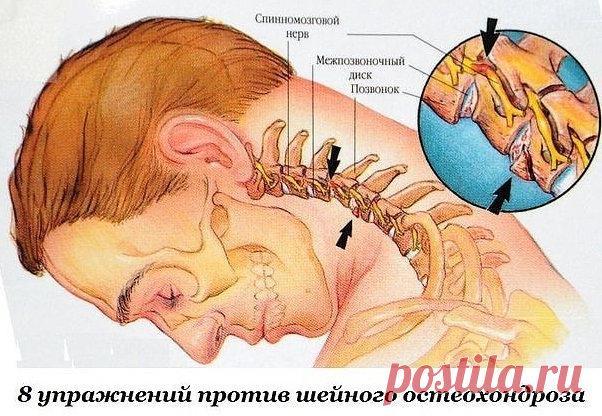 Простые восемь упражнений при шейном остеохондрозе