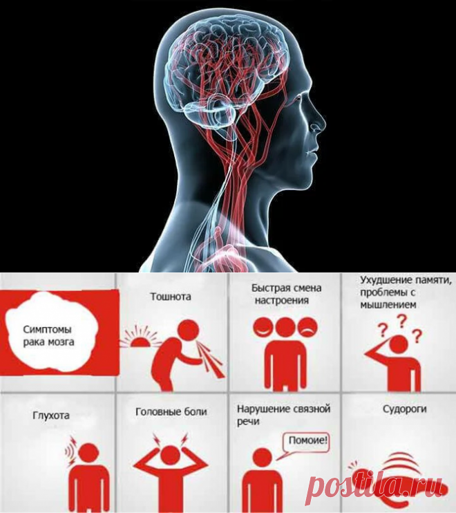 Головная боль ухудшение памяти. Опухоль головного мозга симптомы. Симптоматика опухолей головного мозга. Причины опухоли головного мозга.
