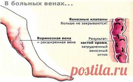 ПОЛЕЗНЫЕ СОВЕТЫ ДЛЯ ЗДОРОВЬЯ ✪ Сохраните чтобы не потерять.СОВЕТ 1 : У всех дома есть это средство от варикоза, но никто о нем не знаетПочти каждый из нас знает, что такое варикоз. Эти «паучьи» сетки появляются на ногах, на руках…