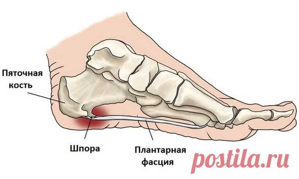ПЯТОЧНАЯ ШПОРА- ЛЕЧЕНИЕ

Штука неприятная и болезненная. Косметологи утверждают, что шпора - это пожизненное приобретение, и никакое лечение не избавит вас от этой проблемы раз и навсегда. Приобретите в аптеке ортопедические стельки, поднимающие свод стопы и разгружающие пятку. Лечить шпоры можно в домашних условиях проверенными методами.
Показать полностью…