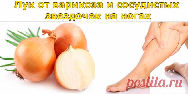Лук от варикоза и сосудистых звездочек на ногах — 3 проверенных рецепта | Полезные советы