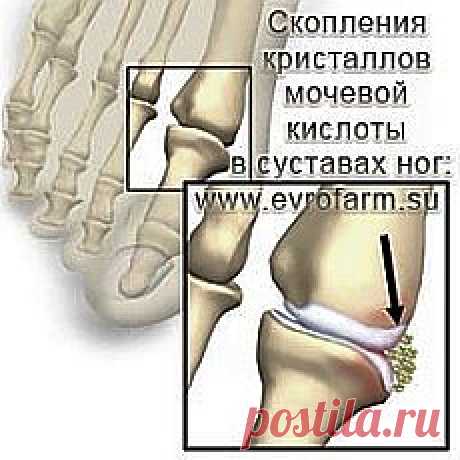 ПОДАГРА И ПОДАГРИЧЕСКИЙ АРТРИТ. НАРОДНЫЕ МЕТОДЫ ЛЕЧЕНИЯ ПОДАГРЫ
