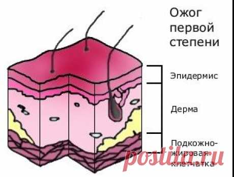 Клиника ожогов у детей.
По глубине повреждения различают 4 степени ожога.