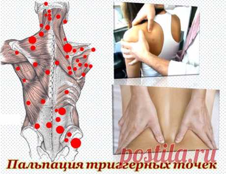Триггерные точки. Что это такое?
