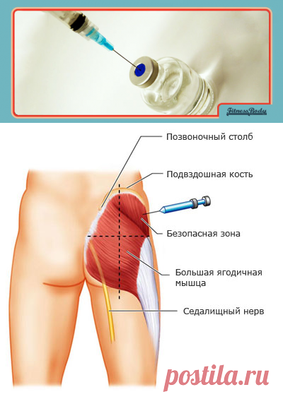 Как выглядит шишка после укола