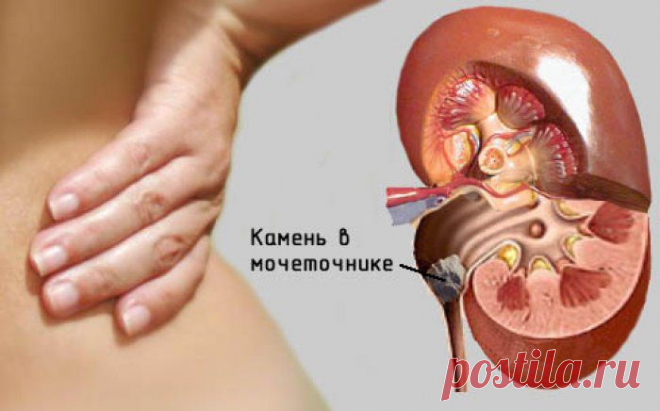 Камни в почках - симптомы, диагностика и лечение