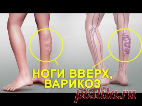 КАК ЛЕЧИТЬ ВАРИКОЗ ДОМА