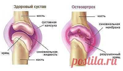 Болят колени, лечение народными средствами