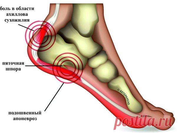 Эффективное лечение пяточной шпоры