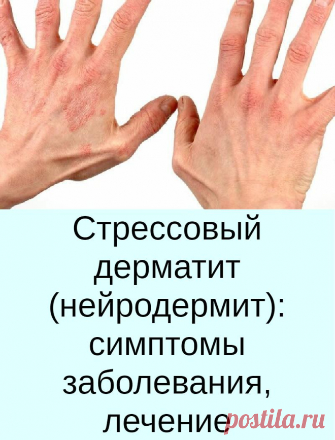Нейродермит симптомы и лечение фото у взрослых Дерматит на ногах у взрослых, в том числе варикозный, инфекционный: симптомы заб