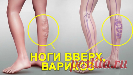 КАК ЛЕЧИТЬ ВАРИКОЗ НА НОГАХ ДОМА Увеличение, переполнение вен кровью зачастую ведет к такому заболеванию, как варикоз на ногах.