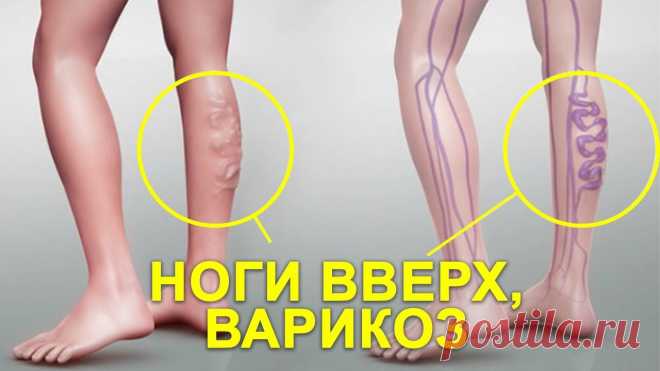 КАК ЛЕЧИТЬ ВАРИКОЗ НА НОГАХ ДОМА Увеличение, переполнение вен кровью зачастую ведет к такому заболеванию, как варикоз на ногах.