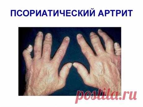 Неліктен буындар псориазға әсер етеді?
Генетикалық бейімділік: иммундық механизмдер
Клиникалық көрініс Аурудың жіктелуі Патологияны қалай күтуге болады
Анамнез және клиникалық көріністер. Лабораториялық мәліметтер
Патологияны қалай емдеу керек
Ішкі қолдануға арналған дәрі-дәрмектер Сыртқы қолдануға арналған дәрілік препараттарФизиотерапия
Псориаттық артрит кезінде қалай жеуге керек? Ауруды емдеуге арналған дәстүрлі емес әдістер. Психиатриялық артритпен емдеуде апертуралы. ...