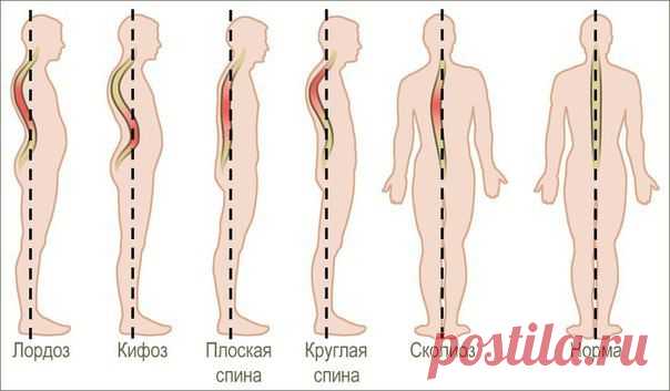 Война с Сутулости - 5 эффективных упражнений..