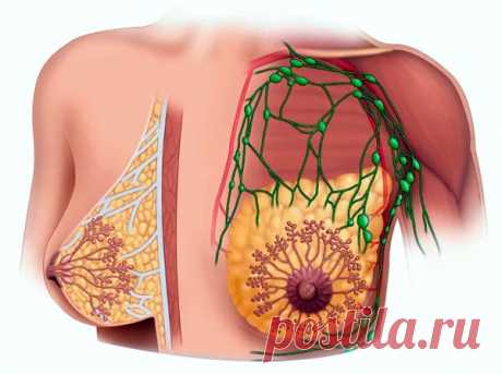 Киста молочной железы: причины, диагностика, лечение
