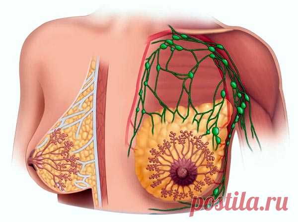 Киста молочной железы: причины, диагностика, лечение