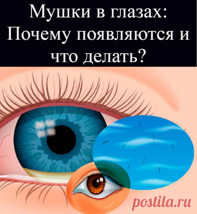 Мушки в глазах: Почему появляются и что делать?