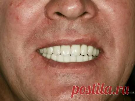 Установка индивидуальных абатментов и 14 коронок из диоксида циркония