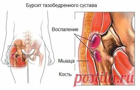 Профилактика и лечение остеохондроза