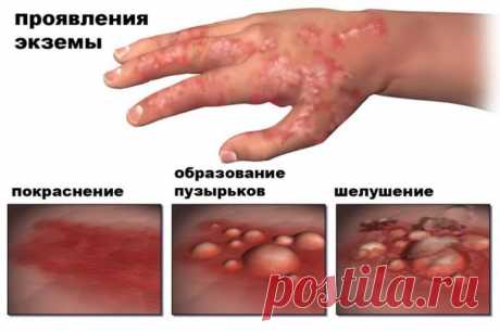 Как избавиться от экземы Если у вас диагностировали экзему (дерматит), вы знаете, как сложно найти облегчение от покраснения, сухости и зуда, которые, кажется, проникают в вашу кожу. Вы также знаете, что некоторые внебиржевые...