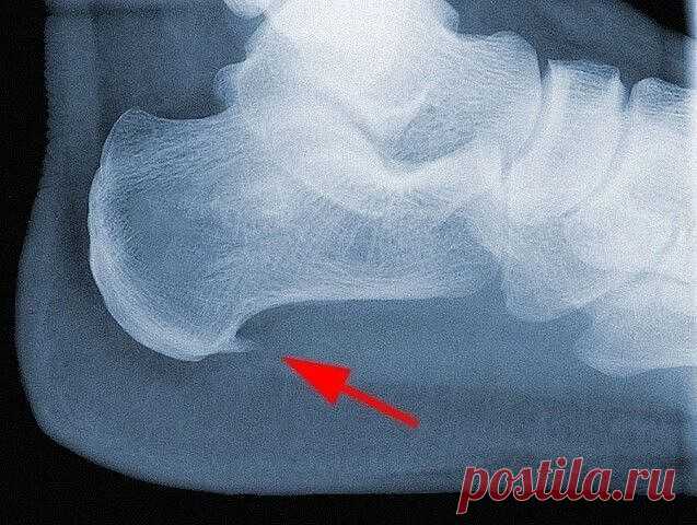 ШПОРУ ВЫЛЕЧИЛА ЗА 3 ДНЯ  
 
Поделюсь рецептами от пяточных шпор. Прошлым летом на юге после ванн у меня так разболелась нога, что я не знала, куда ее деть. Пятка горела огнем. Приехав домой, побежала к хирургу. Молодая врач сделала снимок и объявила, что у меня после ванн обострилась пяточная шпора. Дала мне какую-то «памятку» - и все. Я поняла, что надо самой лечиться. Обратилась к народной медицине - стала искать рецепты от шпор. Все, что нашла, выписала и посылаю вам. В...