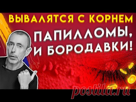 ВЫВАЛЯТСЯ С КОРНЕМ ПАПИЛЛОМЫ, БОРОДАВКИ! 5 Наилучших Копеечных Способов!