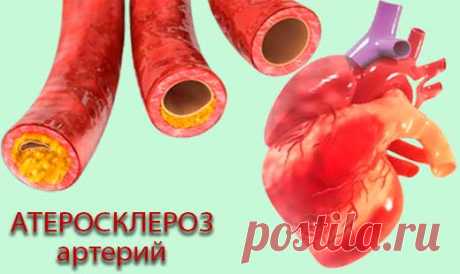Атеросклероз артерий: симптомы, причины и лечение