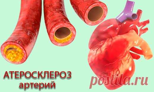 Атеросклероз артерий: симптомы, причины и лечение