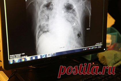 Выявлена ключевая причина развития рака у больных ВИЧ. Ученые Калифорнийского университета в Дэвисе выявили одну из ключевых причин развития рака у пациентов, живущих с ВИЧ (вирус иммунодефицита человека). Оказалось, что этому способствует генетическая способность герпесвируса, ассоциированного с саркомой Капоши, которая приводит к ослаблению иммунного ответа организма.
