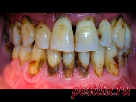 Удалите ЗУБНОЙ КАМЕНЬ за 2 Дня! Когда вы Увидите этот МЕТОД, вы будете сердиться на стоматолога...