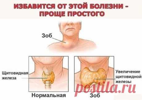 Проще простого: йод, хвойный отвар и лавровый лист. Бабушкины рецепты.
Мне уже 76 лет, много пережито и испытано в жизни, столько болезней перенесла. Вот и хочу поделиться опытом. Как я излечила зоб. Выросла я на реке Ангаре, в воде которой очень мало йода. Наверное, в этом одна из причин того, что зоб - довольно распространенное заболевание среди жителей тех краев. Когда попала в Иркутскую областную клинику на консультацию к эндокринологу, то, увидев больных с нарушением щитовидной железы, при