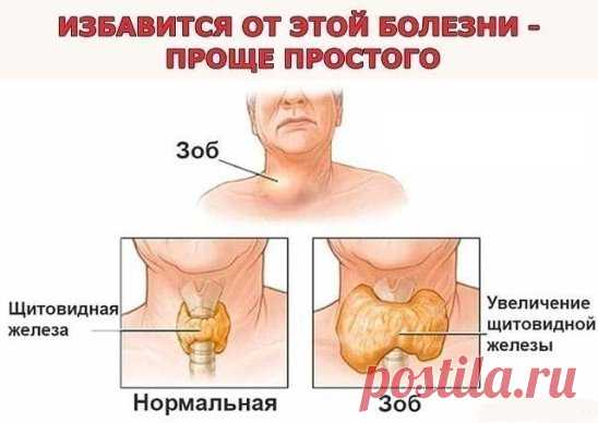 Проще простого: йод, хвойный отвар и лавровый лист. Бабушкины рецепты.
Мне уже 76 лет, много пережито и испытано в жизни, столько болезней перенесла. Вот и хочу поделиться опытом. Как я излечила зоб. Выросла я на реке Ангаре, в воде которой очень мало йода. Наверное, в этом одна из причин того, что зоб - довольно распространенное заболевание среди жителей тех краев. Когда попала в Иркутскую областную клинику на консультацию к эндокринологу, то, увидев больных с нарушением щитовидной железы, при