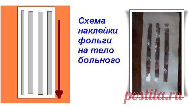 Лечение при помощи алюминиевой фольги | Правила здоровья и долголетия