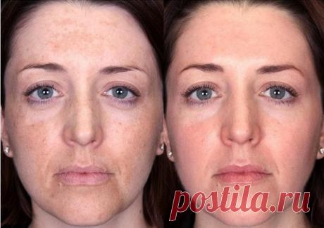 Гликолевый пилинг: для лица, виды, поверхностный, срединный, глубокий, показания, противопоказания, отзывы и результаты, фото до и после, цена, беременность, можно ли летом, уход, химический, что это такое, где купить, 10, 30, 50, 70