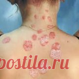 Причини появления псориаза у взрослых и его симптомы