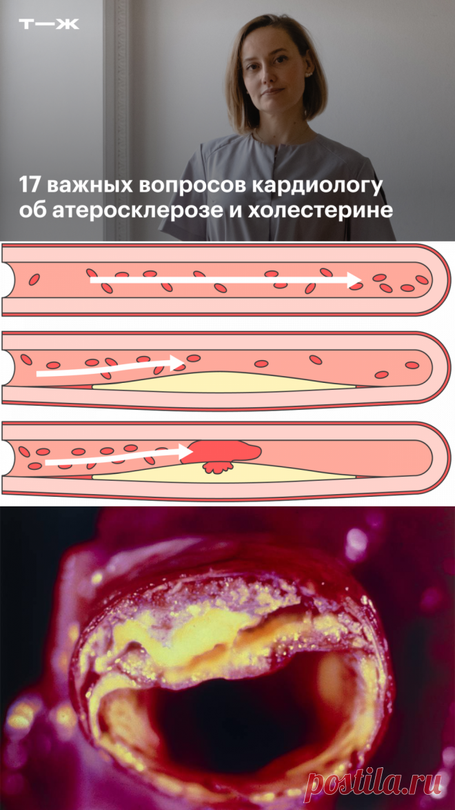 17 важных вопросов кардиологу об атеросклерозе и рисках заболеваний сердца