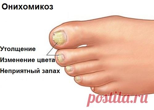 Онихомикоз: что делать с грибком на ногах? - Шаг к Здоровью
