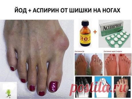 От шишки на ногах

ЙОД И АСПИРИН ОТ ШИШКИ НА НОГАХ
«Аптечным коктейлем» в шутку называется смесь йода и аспирина. Для его приготовления 5 таблеток аспирина нужно растворить в 10-миллиграммовой бутылочке йода. Бутылочку тщательно взболтать. Аспирин растворится, а йод станет бесцветным. Этим раствором нужно на ночь смазывать больное место - наросты на руках или косточки на ногах, после этого тепло их укутать. Например, на руки можно надеть теплые перчатки, на ноги - носки. «...