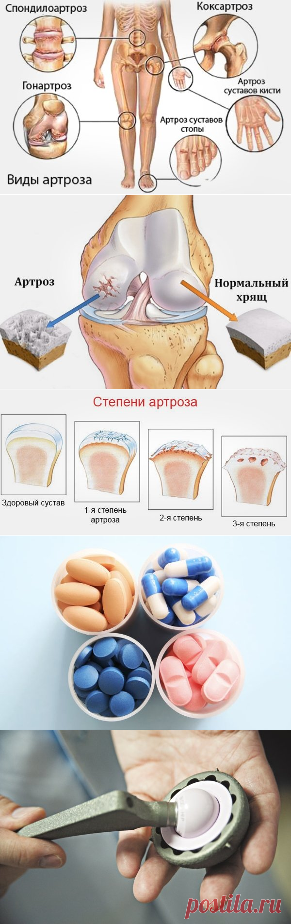 Что такое артроз: его виды, симптомы и методы его лечения