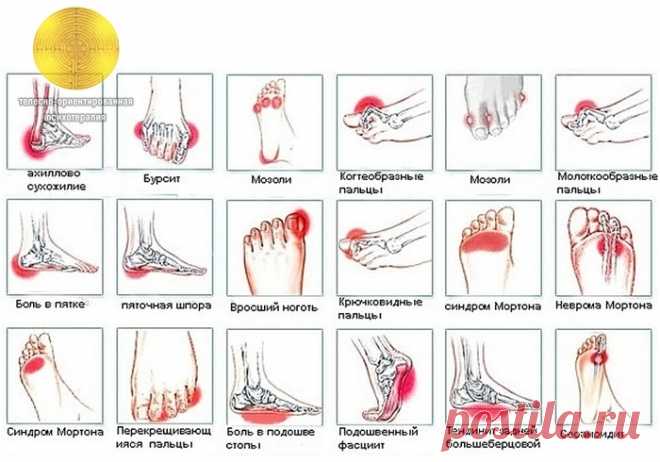 БОЛИ В СТОПЕ....