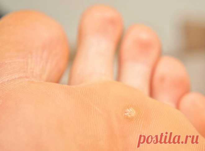 ШИПИЦА НА СТУПНЕ: ЛЕЧЕНИЕ И ПРИЧИНЫ... | Познавательный сайт ,,1000 мелочей"