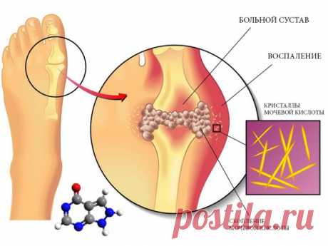 Употребляя эти 7 продуктов вы избавитесь от мочевой кислоты, подагры и артрита, а также болей в суставах - Женский Журнал Если вы хотите контролировать уровни мочевой кислоты, важно следовать следующим рекомендациям: Даже если у вас уровень мочевой кислоты в норме, эти продукты стоит употреблять! И вот почему! Уриновая кислота — это химический элемент, который наш организм создает автоматически после сжигания веществ, называемых пуринами. Пуринами богаты такие продукты как...