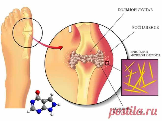 Употребляя эти 7 продуктов вы избавитесь от мочевой кислоты, подагры и артрита, а также болей в суставах - Женский Журнал Если вы хотите контролировать уровни мочевой кислоты, важно следовать следующим рекомендациям: Даже если у вас уровень мочевой кислоты в норме, эти продукты стоит употреблять! И вот почему! Уриновая кислота — это химический элемент, который наш организм создает автоматически после сжигания веществ, называемых пуринами. Пуринами богаты такие продукты как...
