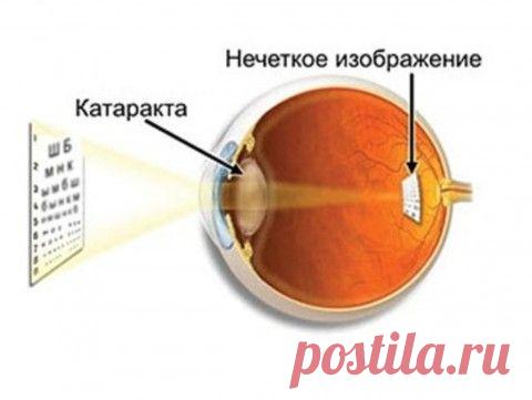 ЧТО ТАКОЕ КАТАРАКТА?